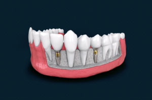 bone grafting for dental implants, Falmouth, MA